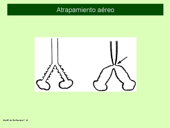 Atrapamiento aéreo Modif. de Bevilacqua F. id. 