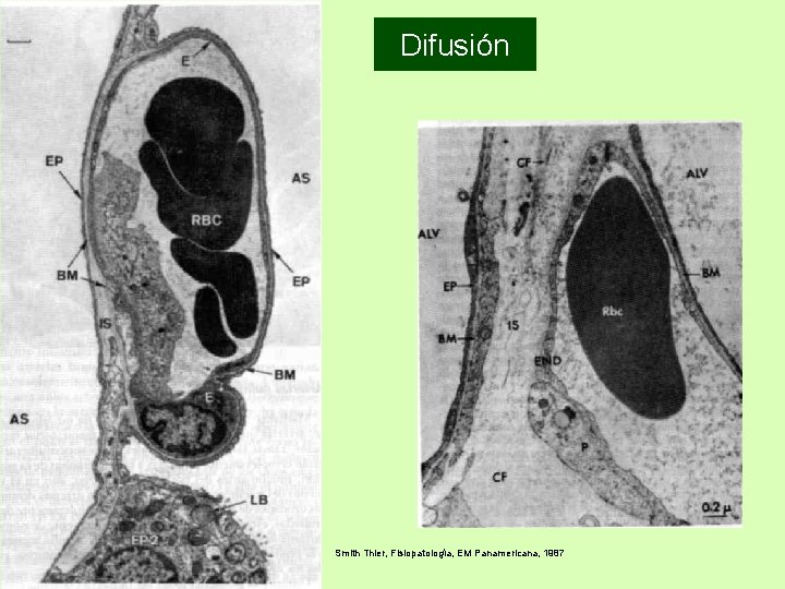 Difusión Smith Thier, Fisiopatología, EM Panamericana, 1987 