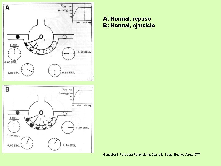 A: Normal, reposo B: Normal, ejercicio González I: Fisiología Respiratoria, 2 da. ed. ,