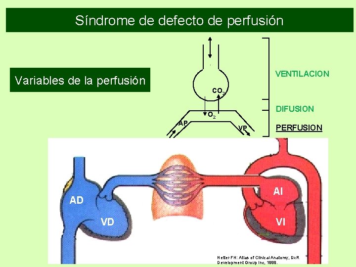 Síndrome de defecto de perfusión VENTILACION Variables de la perfusión CO 2 DIFUSION O