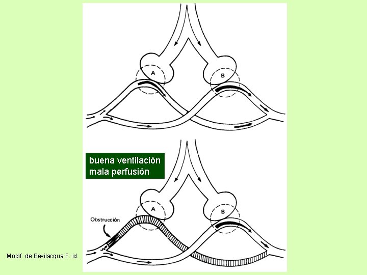 buena ventilación mala perfusión Modif. de Bevilacqua F. id. 