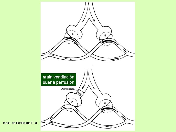 mala ventilación buena perfusión Modif. de Bevilacqua F. id. 