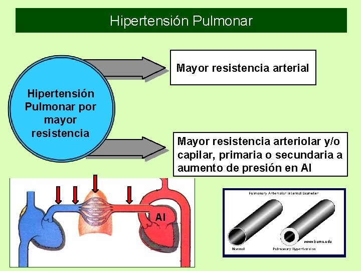 Hipertensión Pulmonar Mayor resistencia arterial Hipertensión Pulmonar por mayor resistencia Mayor resistencia arteriolar y/o