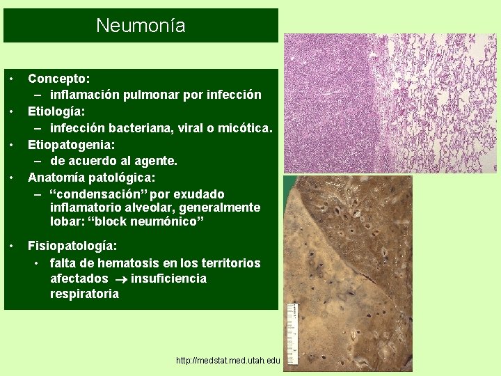 Neumonía • • • Concepto: – inflamación pulmonar por infección Etiología: – infección bacteriana,