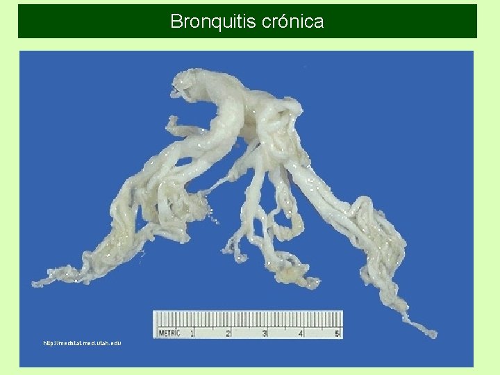 Bronquitis crónica http: //medstat. med. utah. edu 