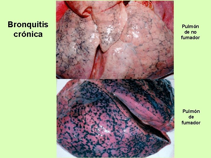Bronquitis crónica Pulmón de no fumador Pulmón de fumador 