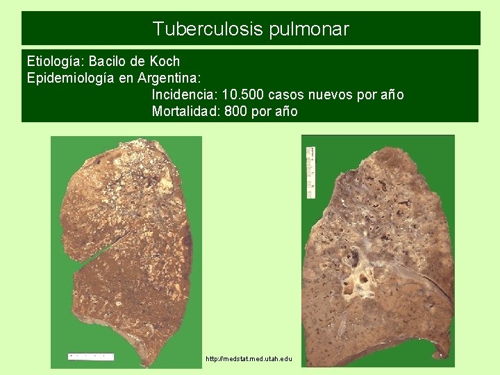 Tuberculosis pulmonar Etiología: Bacilo de Koch Epidemiología en Argentina: Incidencia: 10. 500 casos nuevos