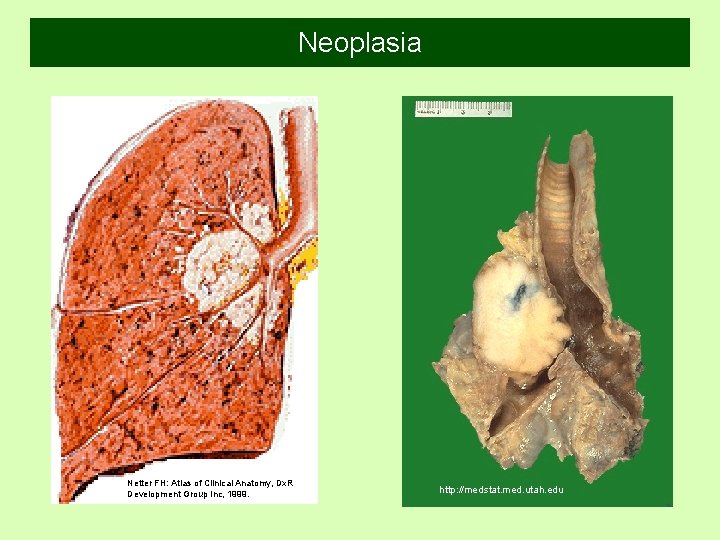 Neoplasia Netter FH: Atlas of Clinical Anatomy, Dx. R Development Group Inc, 1999. http: