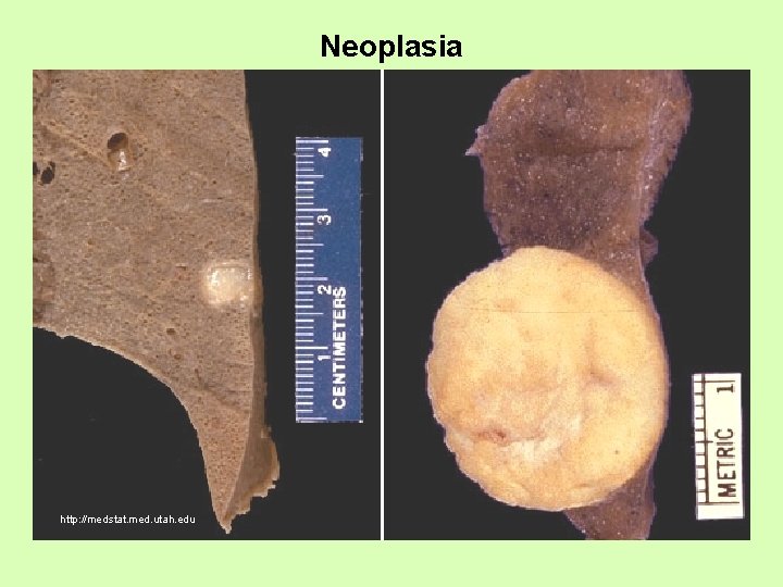 Neoplasia http: //medstat. med. utah. edu 