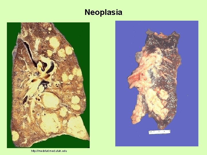 Neoplasia http: //medstat. med. utah. edu 