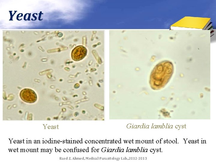 Yeast Giardia lamblia cyst Yeast in an iodine-stained concentrated wet mount of stool. Yeast