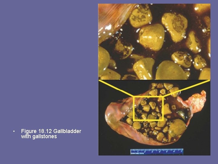  • Figure 18. 12 Gallbladder with gallstones 