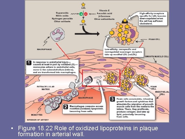  • Figure 18. 22 Role of oxidized lipoproteins in plaque formation in arterial