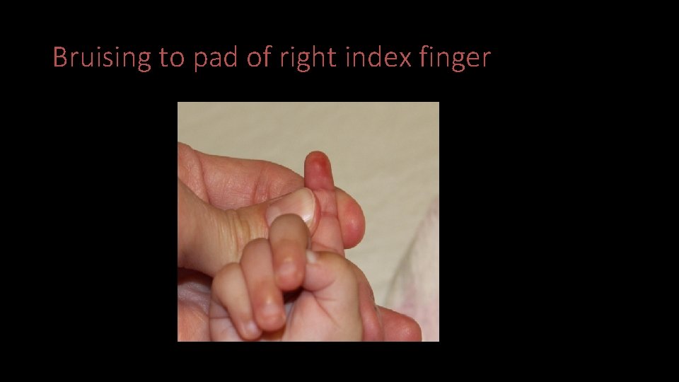Bruising to pad of right index finger 