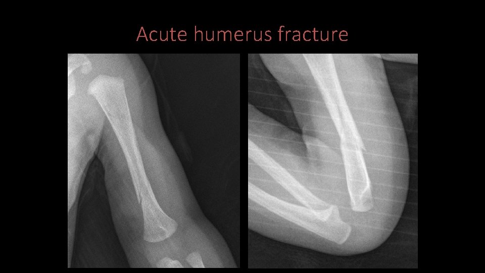 Acute humerus fracture 