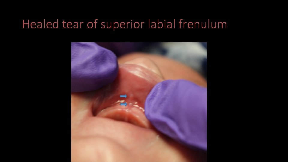 Healed tear of superior labial frenulum 