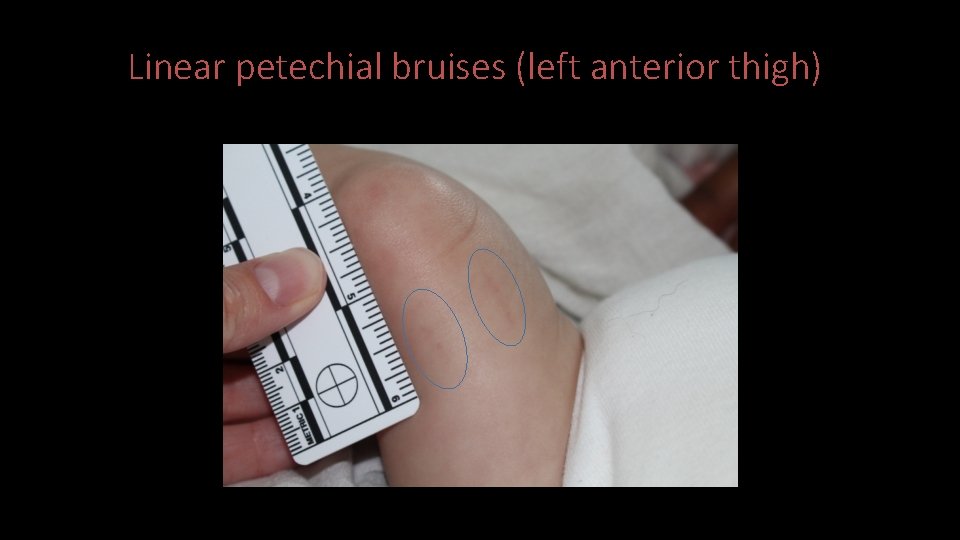 Linear petechial bruises (left anterior thigh) 