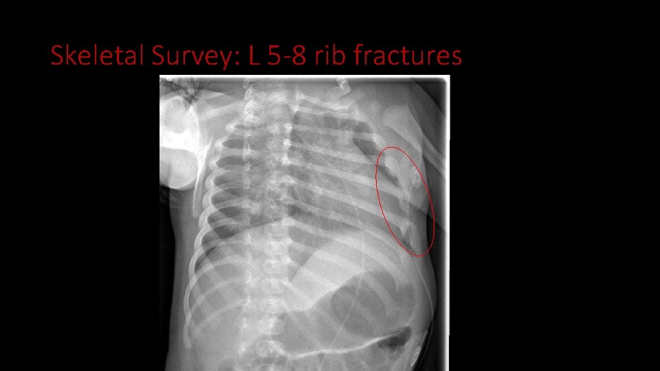 Skeletal Survey: L 5 -8 rib fractures 