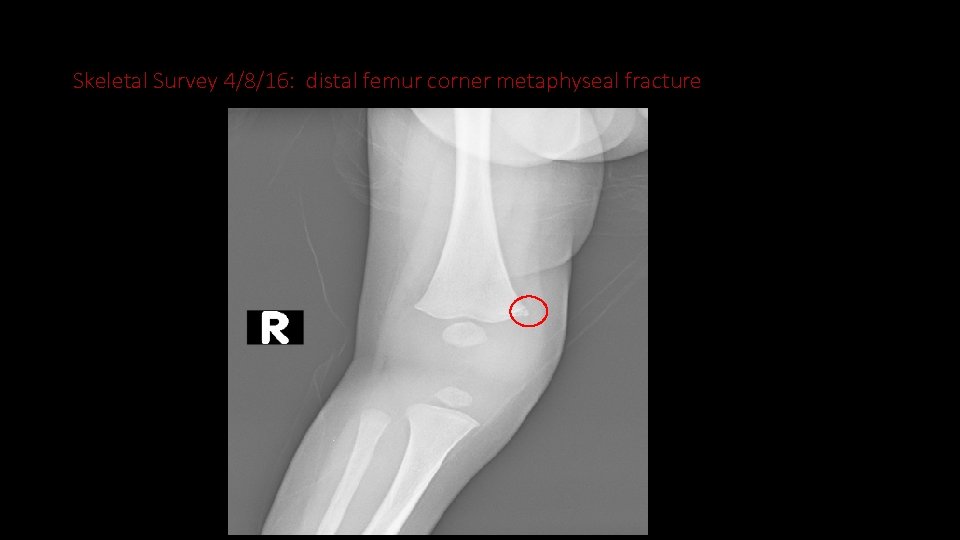 Skeletal Survey 4/8/16: distal femur corner metaphyseal fracture 