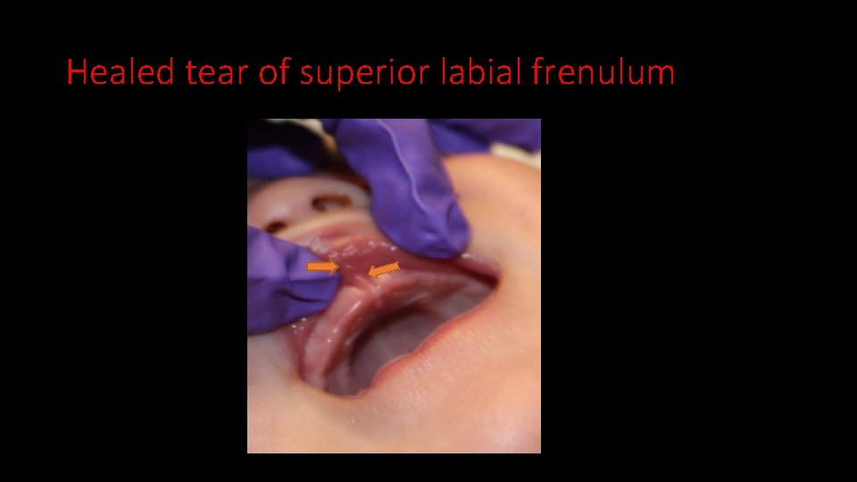 Healed tear of superior labial frenulum 
