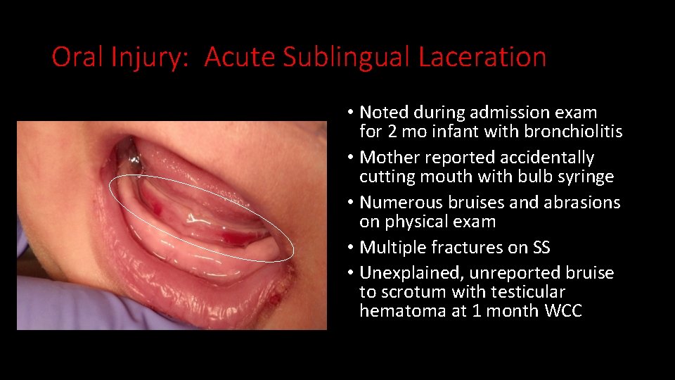 Oral Injury: Acute Sublingual Laceration • Noted during admission exam for 2 mo infant
