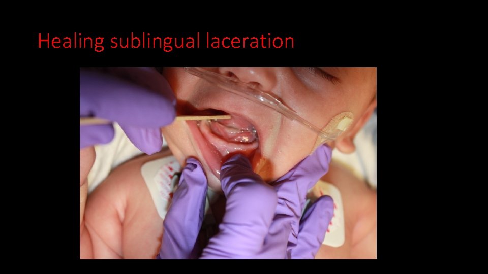Healing sublingual laceration 