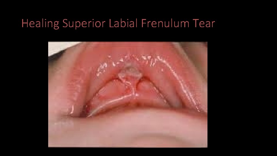 Healing Superior Labial Frenulum Tear 