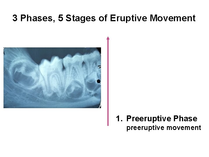 3 Phases, 5 Stages of Eruptive Movement 1. Preeruptive Phase preeruptive movement 