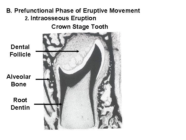 B. Prefunctional Phase of Eruptive Movement 2. Intraosseous Eruption Crown Stage Tooth Dental Follicle