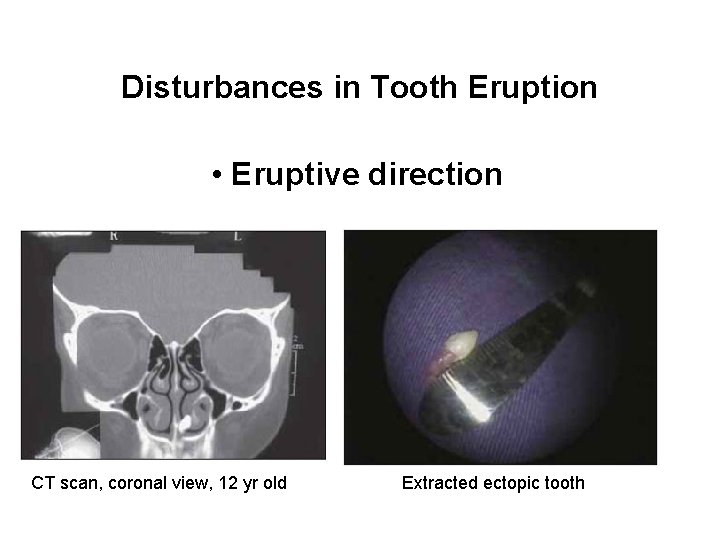 Disturbances in Tooth Eruption • Eruptive direction CT scan, coronal view, 12 yr old