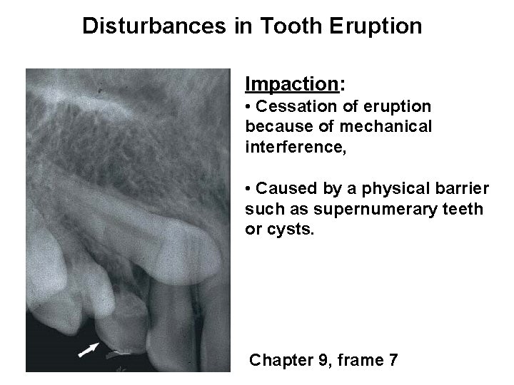 Disturbances in Tooth Eruption Impaction: • Cessation of eruption because of mechanical interference, •