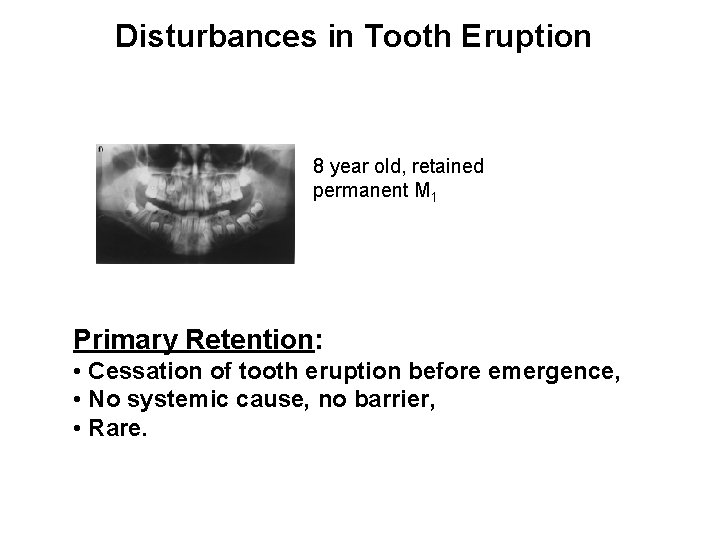 Disturbances in Tooth Eruption 8 year old, retained permanent M 1 Primary Retention: •
