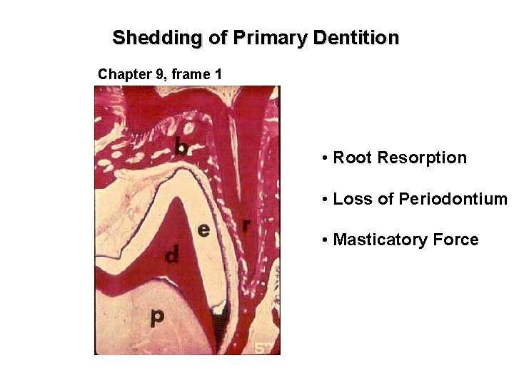 Shedding of Primary Dentition Chapter 9, frame 1 • Root Resorption • Loss of