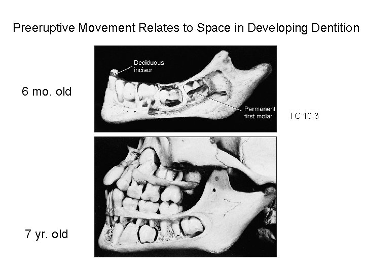 Preeruptive Movement Relates to Space in Developing Dentition 6 mo. old TC 10 -3