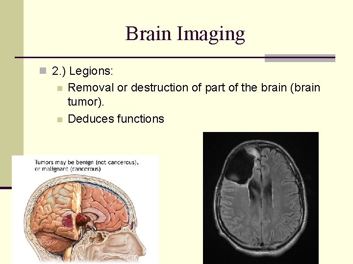 Brain Imaging n 2. ) Legions: n n Removal or destruction of part of