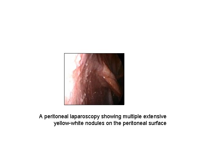 A peritoneal laparoscopy showing multiple extensive yellow-white nodules on the peritoneal surface 