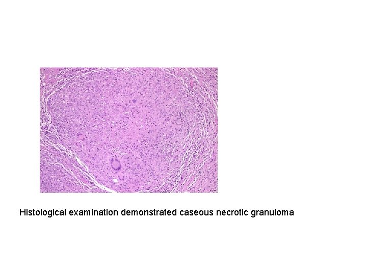 Histological examination demonstrated caseous necrotic granuloma 