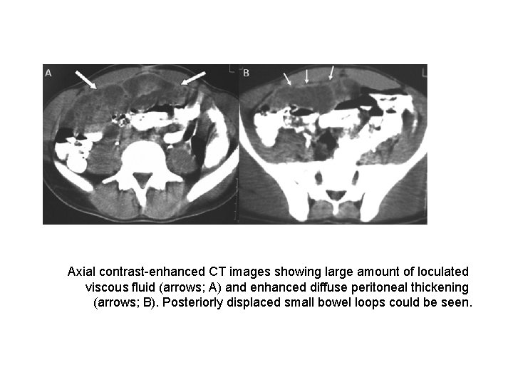 Axial contrast-enhanced CT images showing large amount of loculated viscous fluid (arrows; A) and