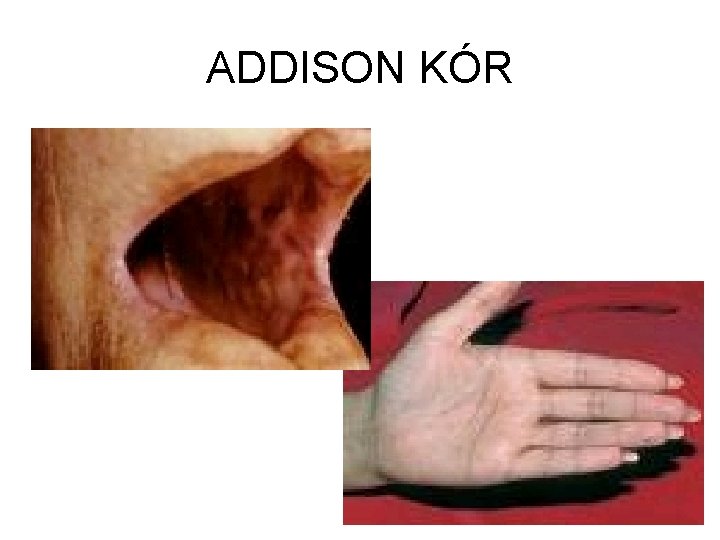 ADDISON KÓR 