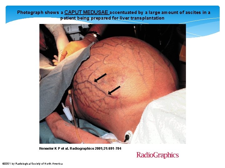  Photograph shows a CAPUT MEDUSAE accentuated by a large amount of ascites in