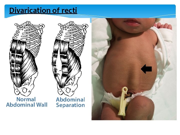 Divarication of recti 