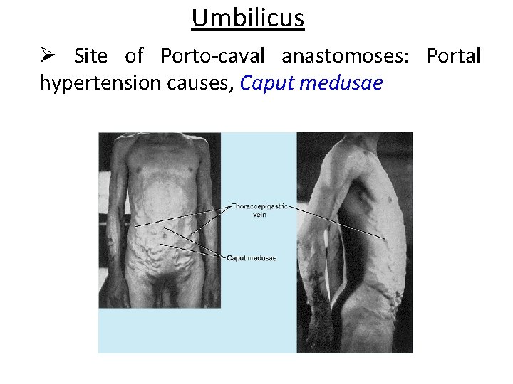 Umbilicus Ø Site of Porto-caval anastomoses: Portal hypertension causes, Caput medusae 