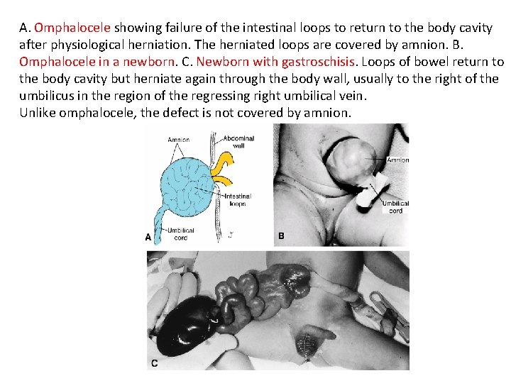 A. Omphalocele showing failure of the intestinal loops to return to the body cavity