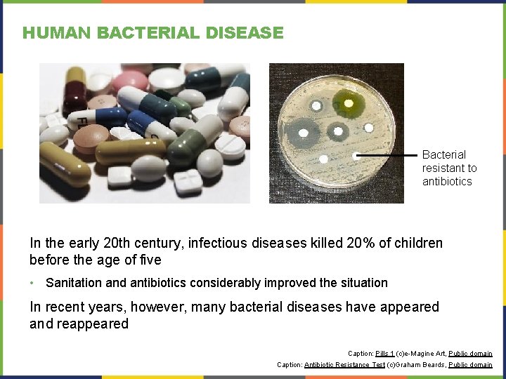HUMAN BACTERIAL DISEASE Bacterial resistant to antibiotics In the early 20 th century, infectious HUMAN BACTERIAL DISEASE Bacterial resistant to antibiotics In the early 20 th century, infectious