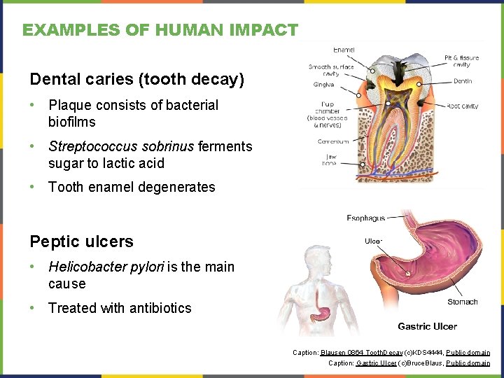 EXAMPLES OF HUMAN IMPACT Dental caries (tooth decay) • Plaque consists of bacterial biofilms EXAMPLES OF HUMAN IMPACT Dental caries (tooth decay) • Plaque consists of bacterial biofilms