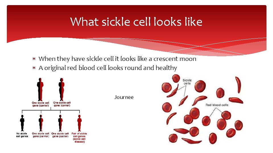 What sickle cell looks like When they have sickle cell it looks like a