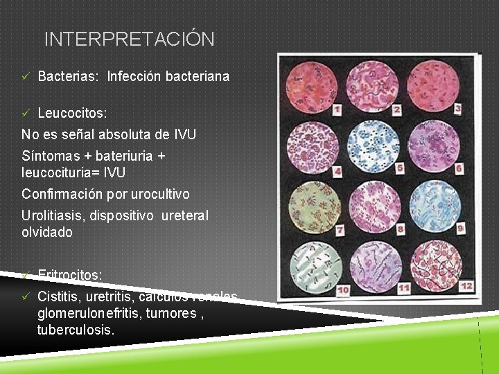 INTERPRETACIÓN ü Bacterias: Infección bacteriana ü Leucocitos: No es señal absoluta de IVU Síntomas