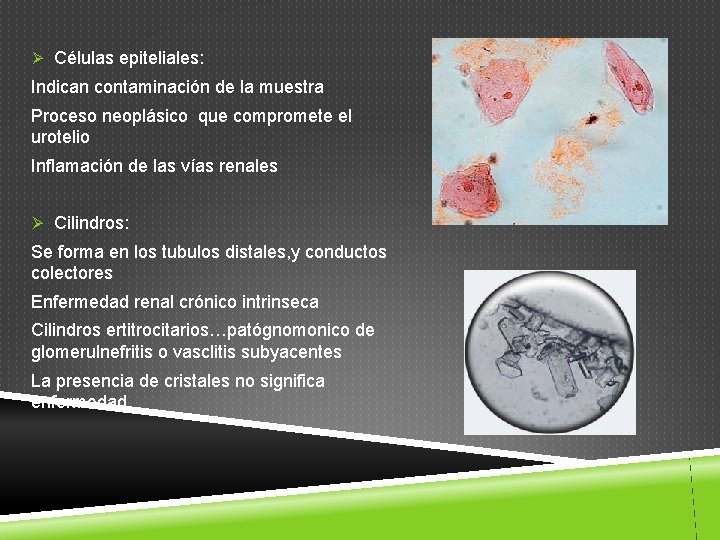 Ø Células epiteliales: Indican contaminación de la muestra Proceso neoplásico que compromete el urotelio