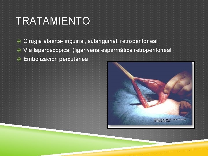 TRATAMIENTO Cirugía abierta- inguinal, subinguinal, retroperitoneal Vía laparoscópica (ligar vena espermática retroperitoneal Embolización percutánea