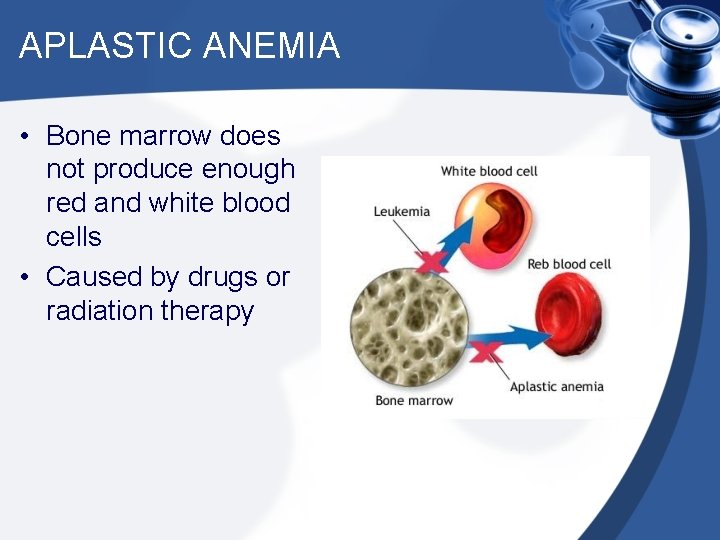 APLASTIC ANEMIA • Bone marrow does not produce enough red and white blood cells